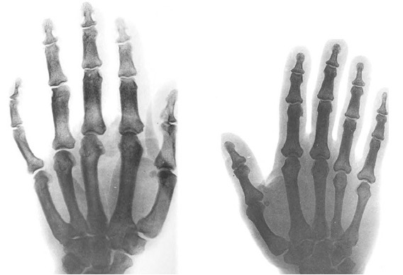 La genómica 3D abre camino a diagnósticos más precisos para detectar trastornos del crecimiento